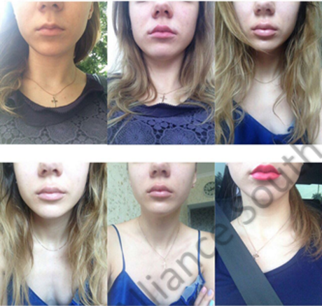 Контурная пластика губ (снимки до, сразу после, через 1 неделю, 2 недели, 3 недели, 1 месяц)